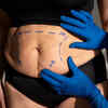 Liposuction