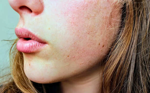 Winter Care of Face