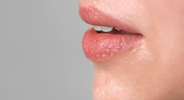Sore lips
