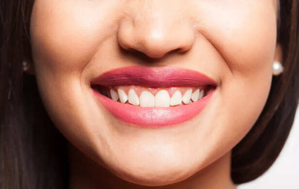 A Perfect Smile - Trendy Whitening Kit