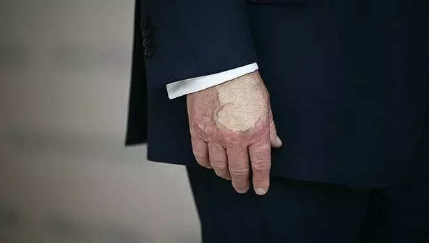 X | @Snehalsays_03 | Donald Trump Seen Dragging Right Leg in Viral New Year’s Video