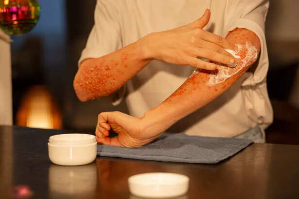 Burn degree burn scars