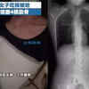 Chinese Woman Fractures 4 Ribs While Coughing After Eating Spicy Food