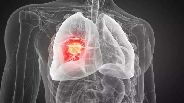 केंद्र सरकार की नई पहल से अब फेफड़ों के कैंसर का इलाज होगा एक समान और वैज्ञानिक।