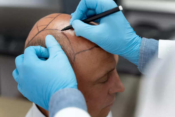 Hair loss treatment