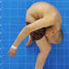 Man Who Lived 'Folded' For 18 Years, Can Finally Stand Straight After ...