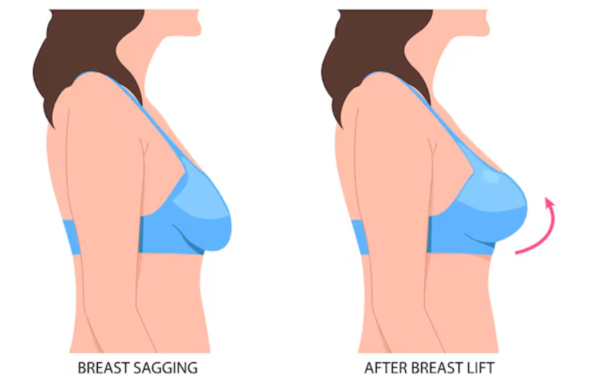 Breast Lift Makes Breasts Bigger