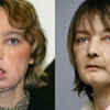 Woman Who Received The World's First Face Transplant Dies Of Cancer 11 ...