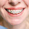 Braces