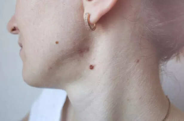 Multiple skin tags around the neck
