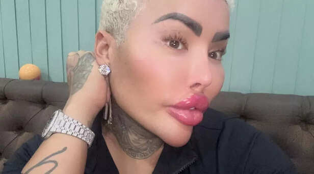 Britain’s ‘Lip King’ Jordan James Parke dies at 36:  Did cosmetic obsession play a role in his untimely death? Here’s what we know