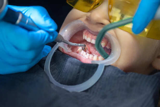 Mistakes in Enamel                 (Image Credit:Freepik)