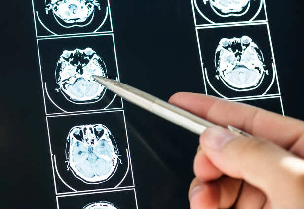 Closeup of brain mri scan result