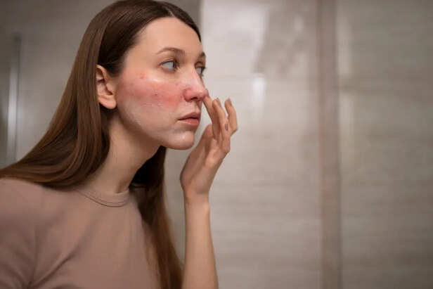Redness on Face                  (Image Credit:Freepik)