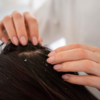 Dandruff in scalp                  (Image Credit:Freepik)