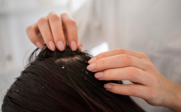 Dandruff in scalp                  (Image Credit:Freepik)