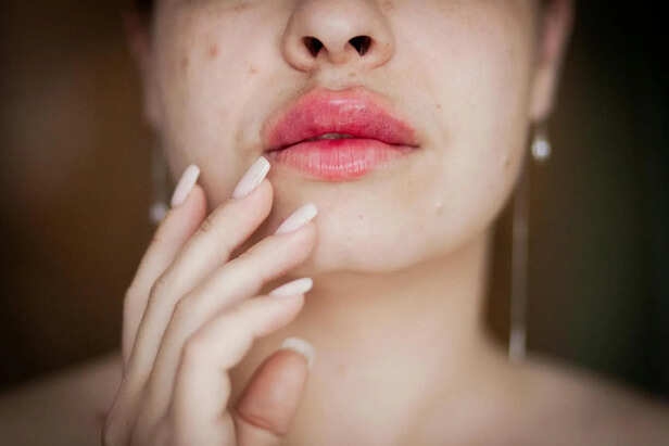 Pimples on lips                (Image Credit:Pexels)