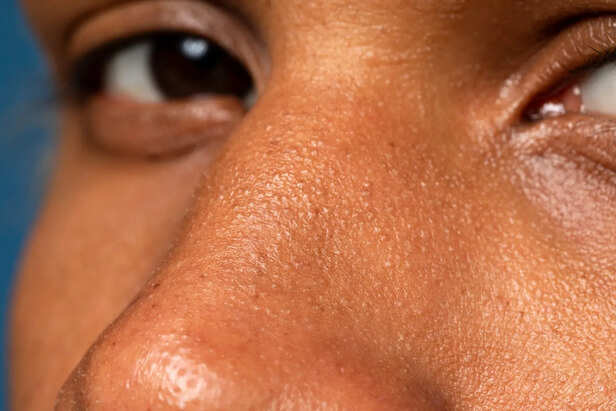 Dry Skin Texture and Flakiness