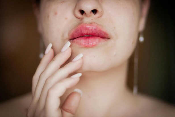 Lips after getting fillers.
