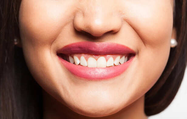 Smile lines