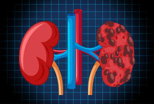 Damaged Kidneys Affecting Blood Sugar Balance