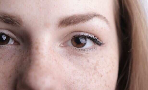 freckles