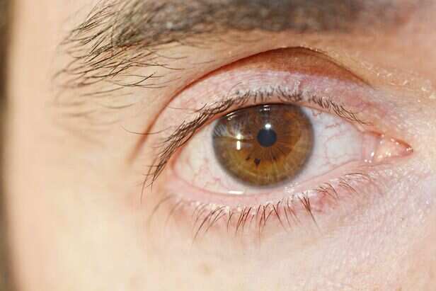 Dry eyes