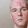 Sunburn