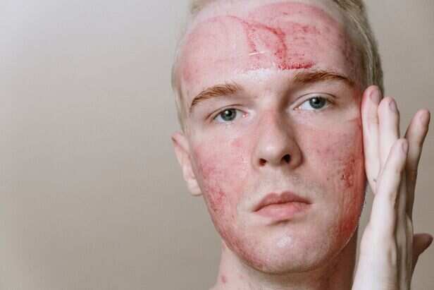 Sunburn