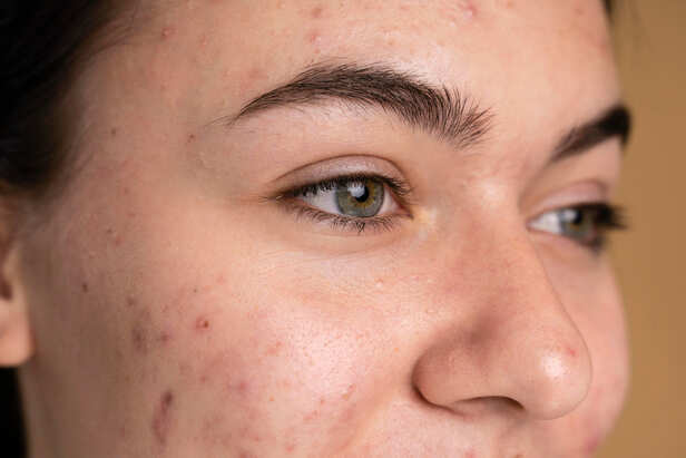 Close-Up of Acne Marks and Healing Skin