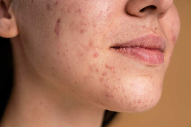How Acne Forms Beneath the Skin
