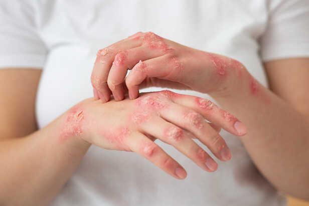 Humid Weather and Skin Health