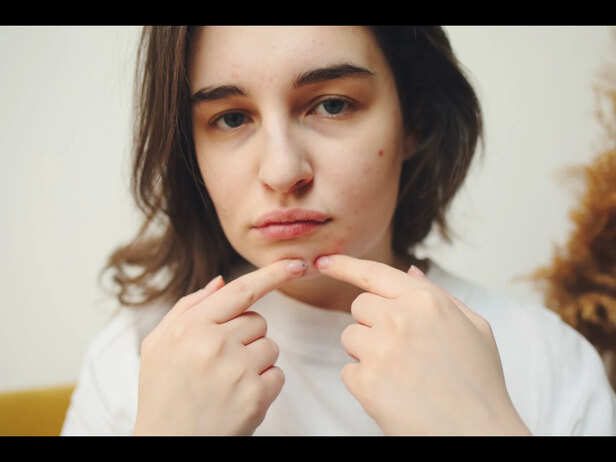 Picking At Facial Acne