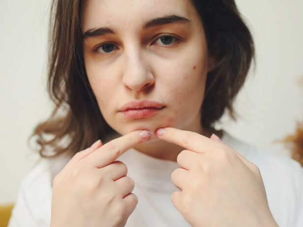 Picking At Facial Acne