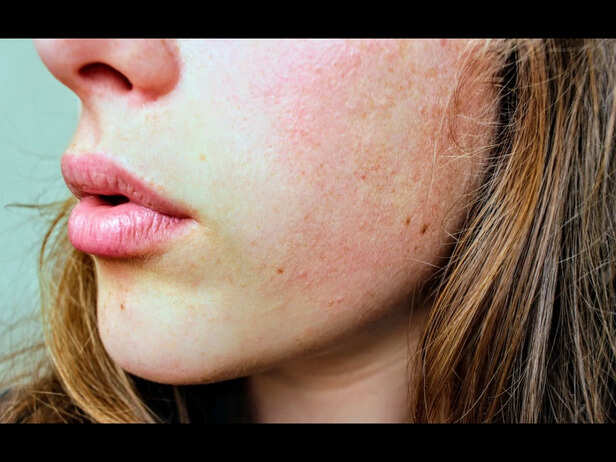 Monsoon Skincare for Healthy Skin