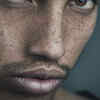 Dry Lips and Dehydrated Skin