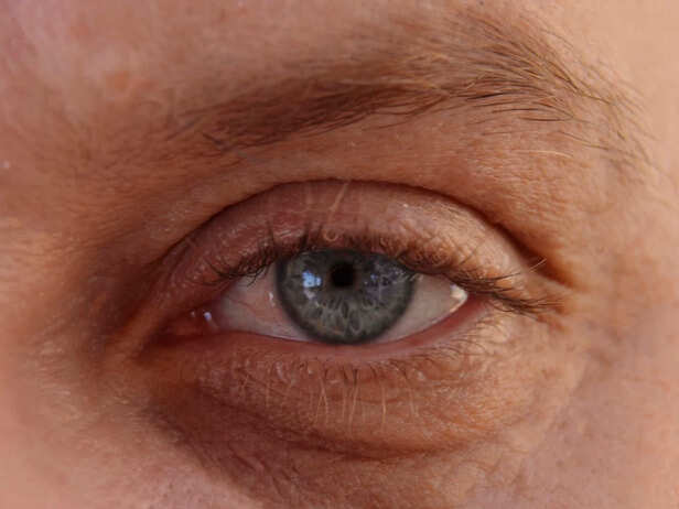 The Everyday Habit Behind Your Puffy Eyes