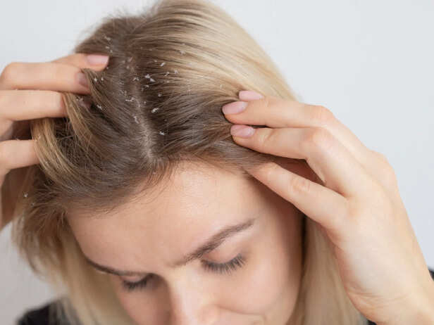 Dandruff Often Worsens During Monsoon