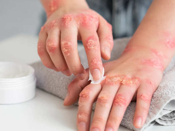 Fungal Infections Are Common in Humid Weather