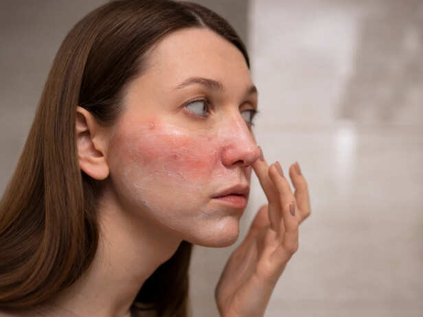 Monsoon Can Trigger Eczema Flare-Ups