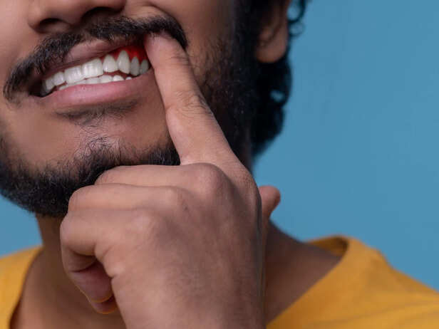 Early Signs of Bleeding Gums