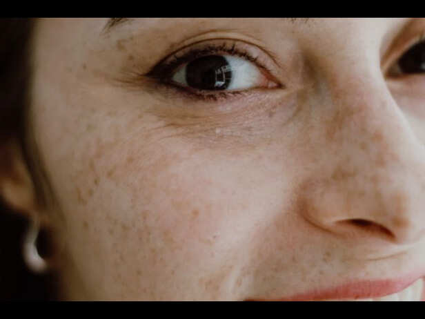 ​ Dry Facial Skin​