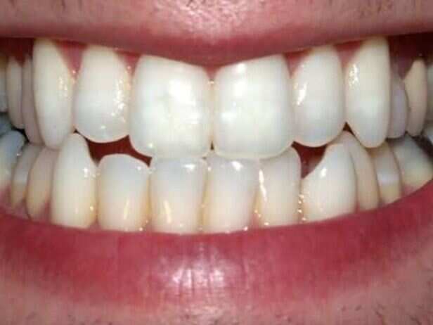 Most people know wisdom teeth as the unwanted guests of adulthood