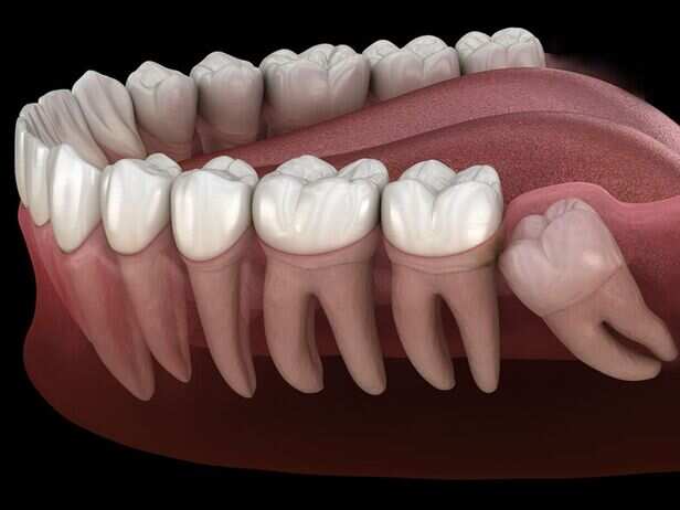 ​These teeth sit at the very back of the mouth and are the last permanent teeth to appear
