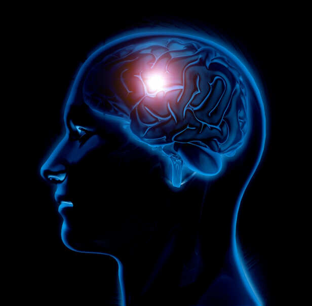 Stroke Risk