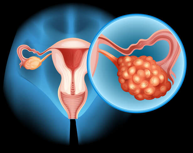 Ovarian Cancer