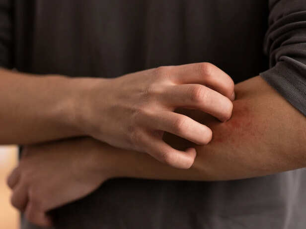 A Calmer Rash Doesn't Mean It's Healing