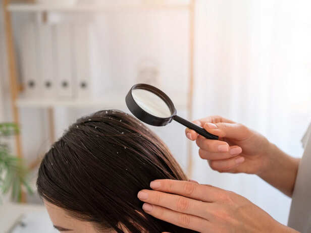 Understanding the Real Cause of Dandruff