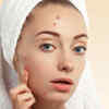 Picking a Pimple Makes It Worse, Not Better