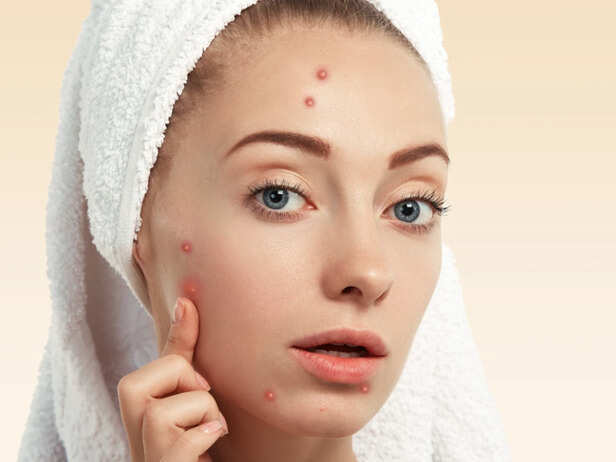 Picking a Pimple Makes It Worse, Not Better